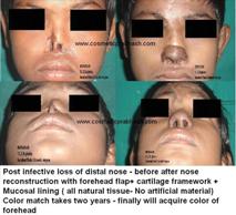 Before After Pictures,Nose job,Rhinoplasty,Delhi,nose reconstruction